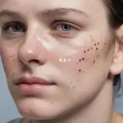 痘疤是否与皮肤质量有关系？如果是的话它如何影响到我们的外貌和自信心？