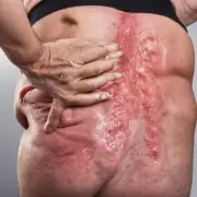 痤疮是一种皮肤病吗？